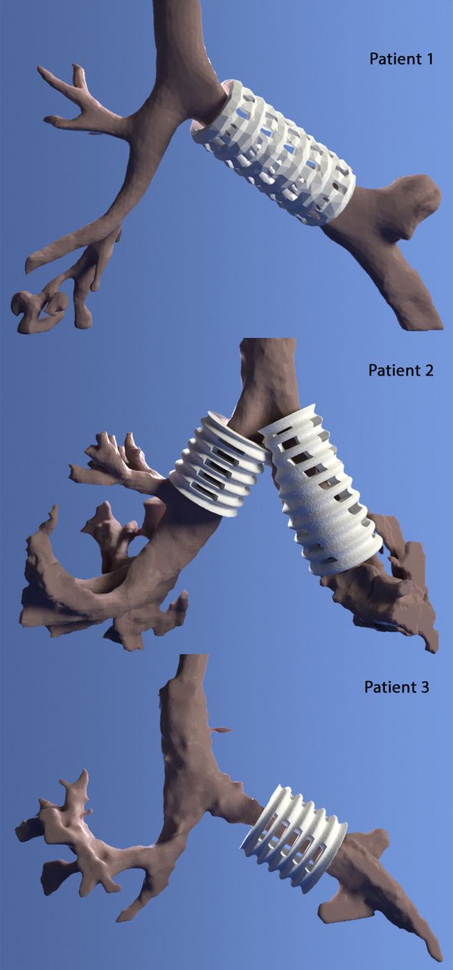 Images of three trachea implants created using CT scans and 3D imaging software 